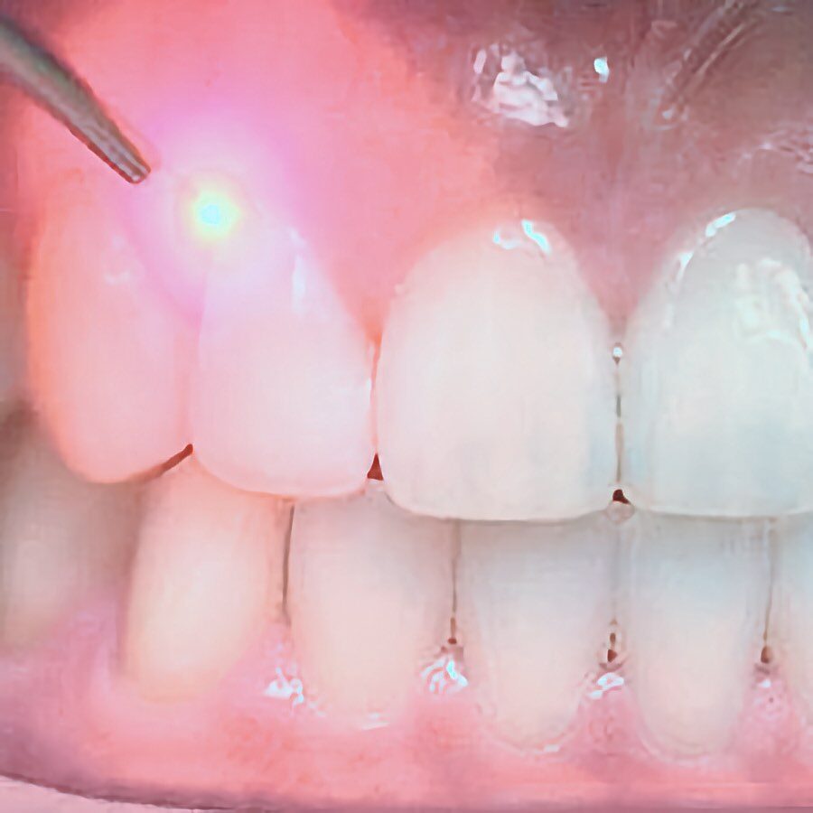 dental-laser2-300